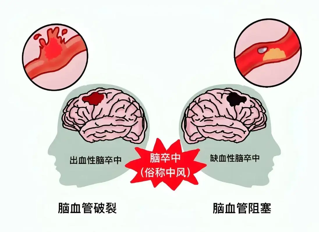 脑卒中一般分为哪两种(图1)