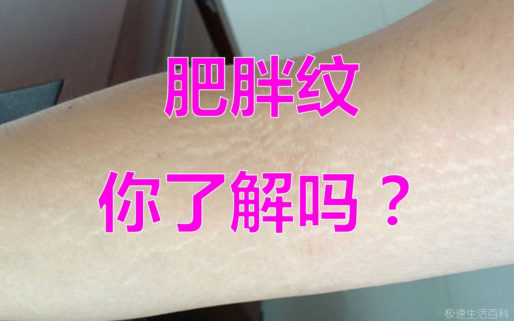 肥胖纹怎么去掉_去除肥胖纹的方法(图4)