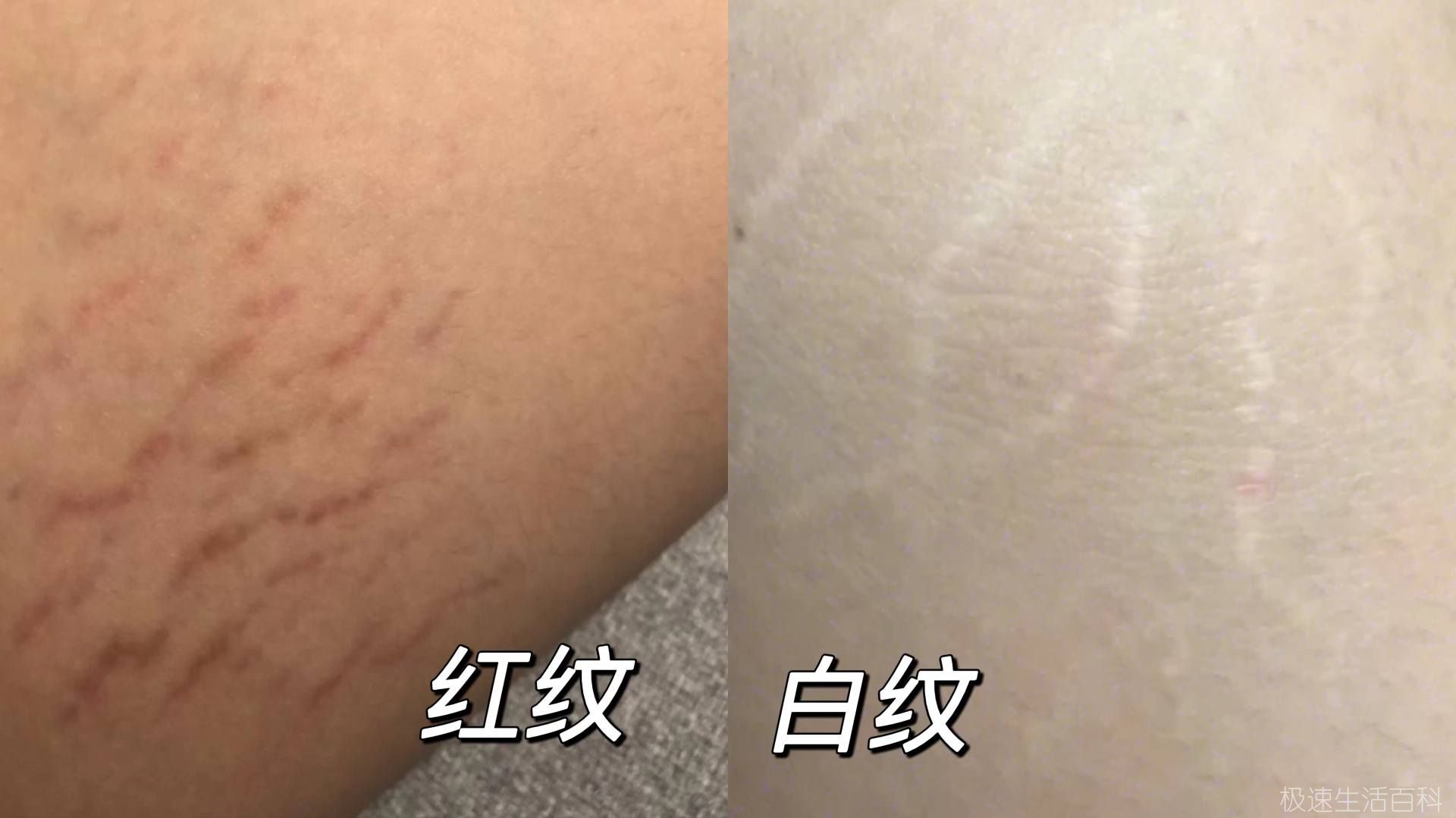 肥胖纹怎么去掉_去除肥胖纹的方法(图2)