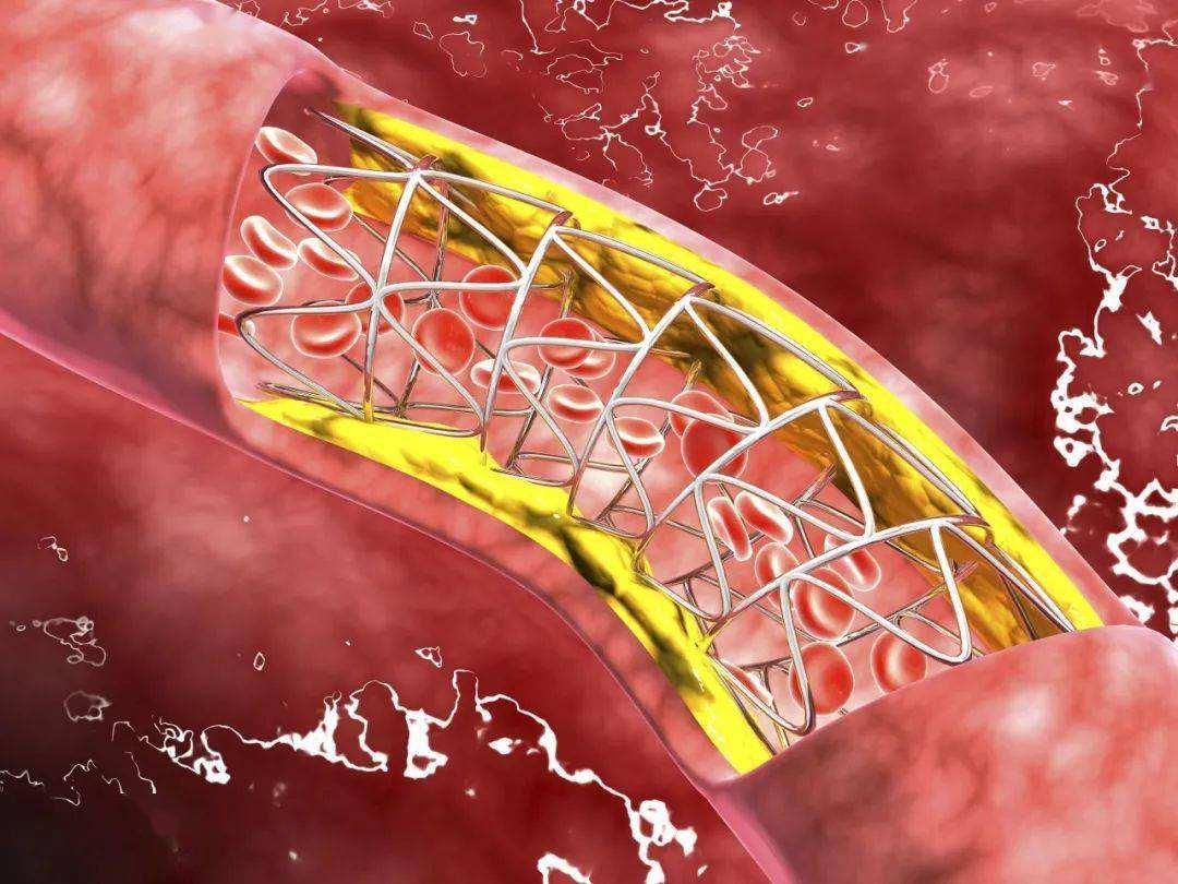 心梗堵的血管可以疏通吗(图3)