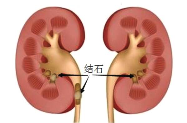 排肾结石的药哪样最好(图1)