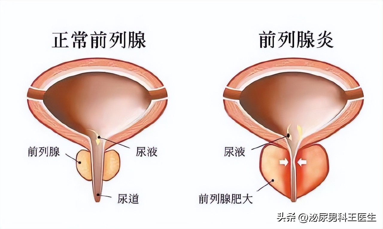 老公前列腺炎能备孕吗(图1)