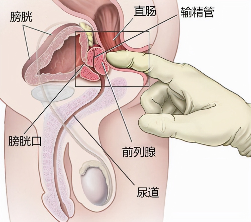 老公前列腺炎能备孕吗(图2)