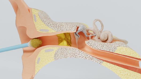 耳朵里面有耳屎没有取出(图2)