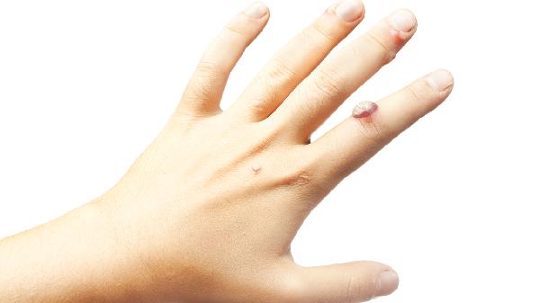 肛门湿疣不知道怎么个事(图1) 肛门湿疣不知道怎么个事(图1)