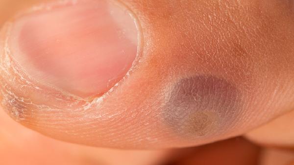 肛门湿疣不知道怎么个事(图2) 肛门湿疣不知道怎么个事(图2)