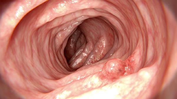 女性输尿管口囊肿怎么治疗(图1) 女性输尿管口囊肿怎么治疗(图1)