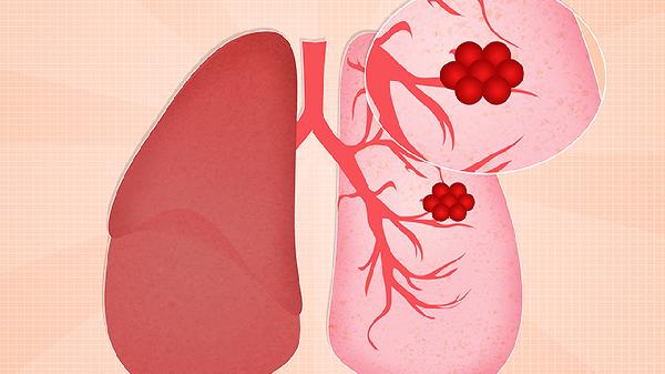 肺脓肿易导致什么并发症(图1)
