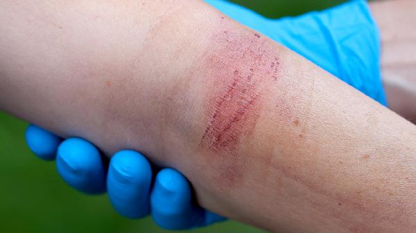 创伤性关节病有哪些典型症状(图2) 创伤性关节病有哪些典型症状(图2)