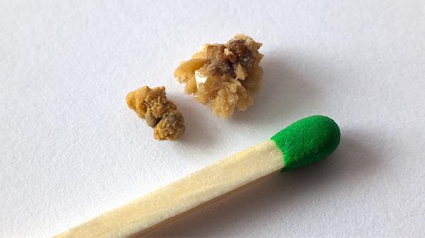 肺结石是什么原因造成的(图2)