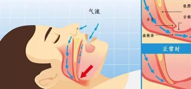 女生打呼噜自我治疗法_女生打呼噜不再尴尬，自我治疗有妙招(图6)