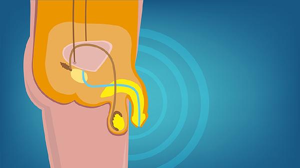 男性前列腺怎么得的(图2)