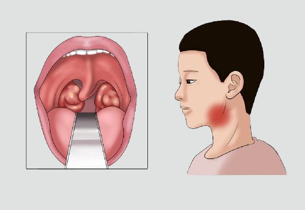 扁桃体总是反复发炎是哪儿的原因(图2)