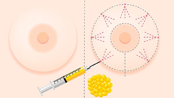 盆腔液性包块要做手术吗(图1)