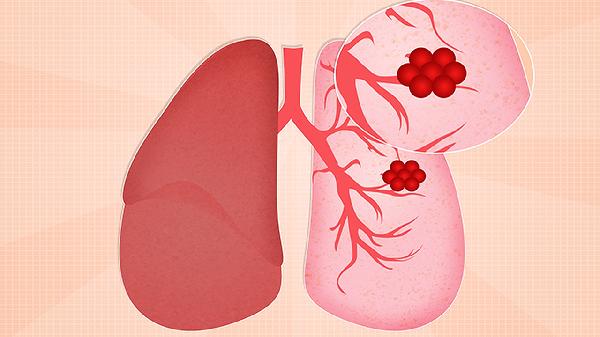 肺上长了个良性肿瘤还能治疗吗(图2)