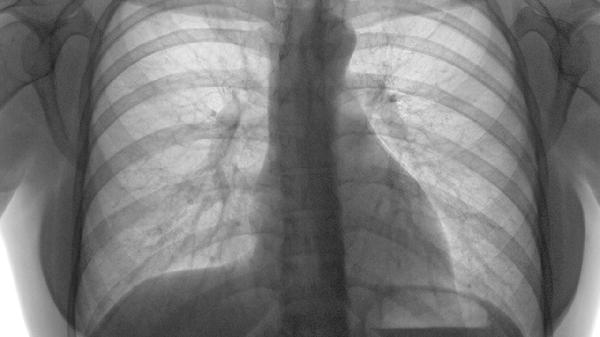 肺门癌一般是什么类型的癌(图1) 肺门癌一般是什么类型的癌(图1)