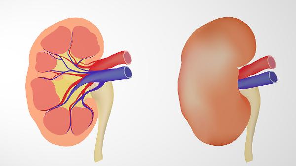 肾囊肿形成的原因及危害有哪些症状(图2)