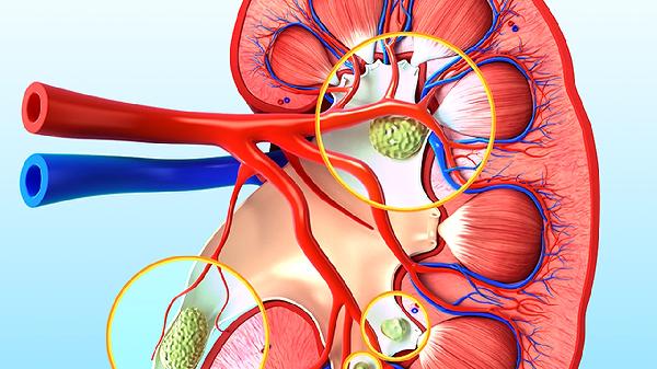 肾囊肿是怎么引起的原因有哪些呢(图3)