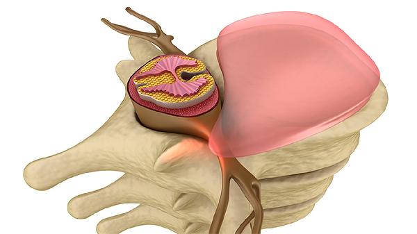椎间盘突出压迫坐骨神经导致脚麻木怎样治疗(图1)