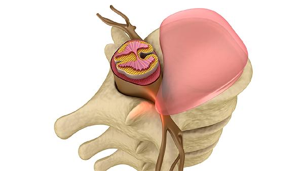 椎间盘突出压迫坐骨神经导致脚麻木怎样治疗(图3)