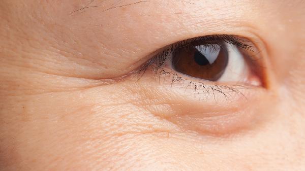 做去鱼尾纹失败修复怎么样?好吗?(图1) 做去鱼尾纹失败修复怎么样?好吗?(图1)