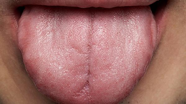 舌头中间有一条很深的竖裂纹是身体不好吗(图2)