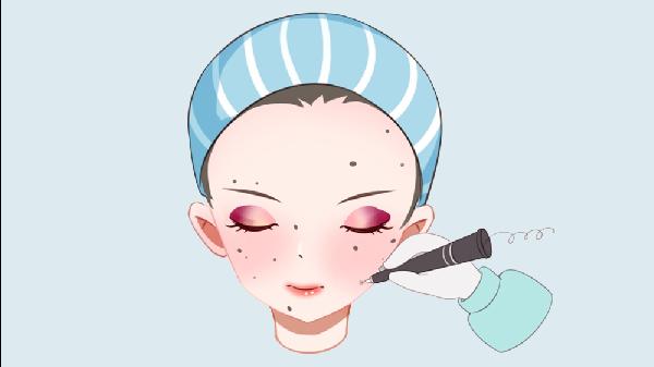 E光去黑痣手术的方法是什么？(图1)