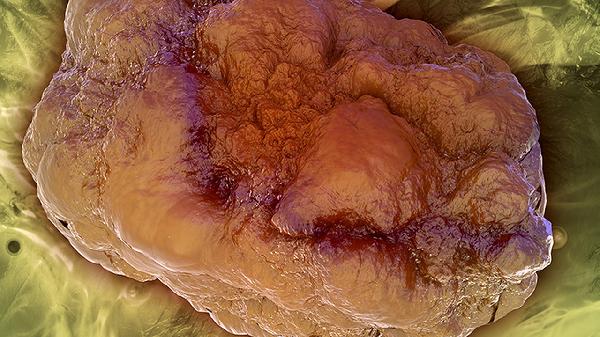 肿瘤化疗患者护理要点有哪些(图2) 肿瘤化疗患者护理要点有哪些(图2)