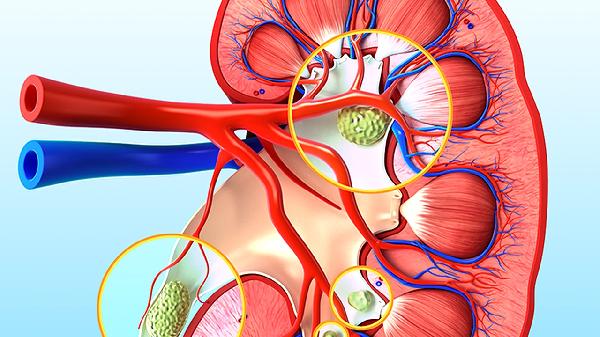 肾囊肿和肾积水的区别是什么(图3) 肾囊肿和肾积水的区别是什么(图3)