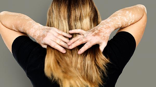 婴儿身上有白斑是怎么回事(图3) 婴儿身上有白斑是怎么回事(图3)