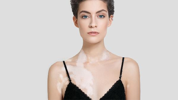 婴儿身上有白斑是怎么回事(图2) 婴儿身上有白斑是怎么回事(图2)