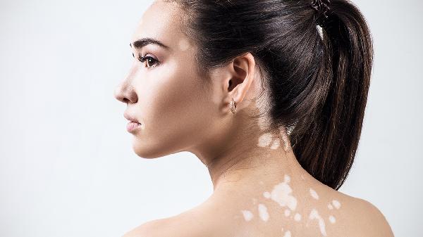 婴儿身上有白斑是怎么回事(图1) 婴儿身上有白斑是怎么回事(图1)