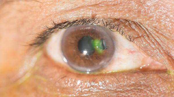 白内障手术后眼干眼涩咋回事(图2) 白内障手术后眼干眼涩咋回事(图2)