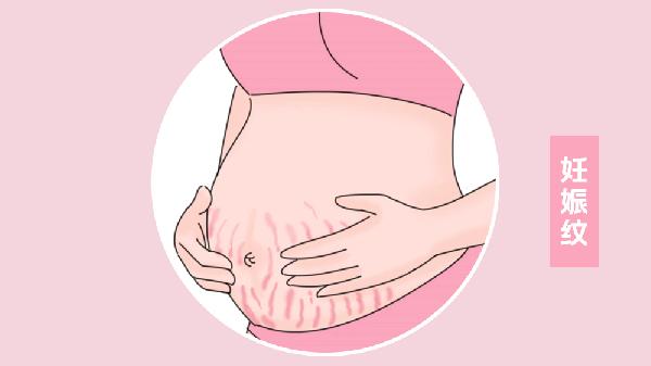 怎样使用橄榄油预防妊娠纹增生(图2)