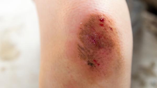 肺脓肿有生命危险吗能治好吗能活多久(图1)