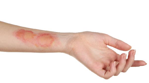 肺脓肿有生命危险吗能治好吗能活多久(图2)