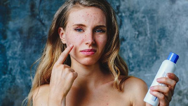 青春期时该怎样预防青春痘(图1) 青春期时该怎样预防青春痘(图1)