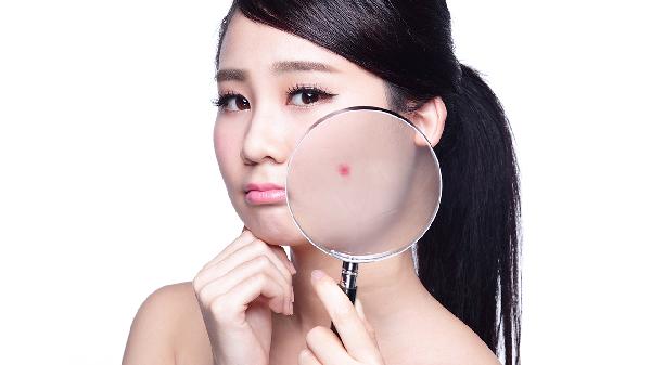 青春期时该怎样预防青春痘(图2) 青春期时该怎样预防青春痘(图2)