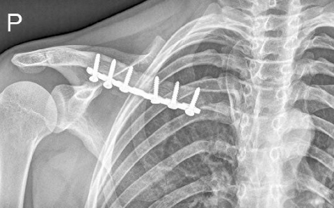 右锁骨上淋巴结肿大是什么原因