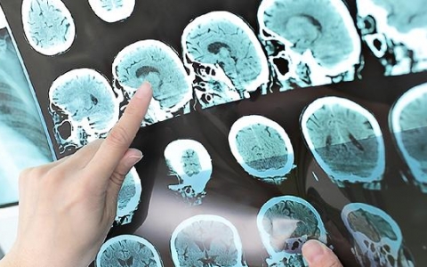 陈旧性脑梗死什么意思