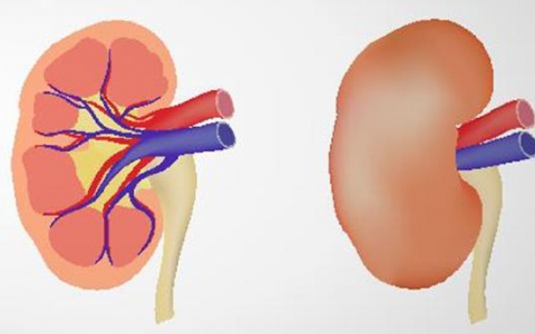 结石脓肾的治疗与恢复方法
