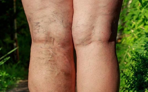 盆壁水肿的原因是什么