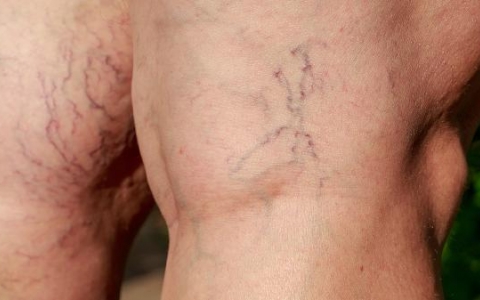 四肢水肿的原因有哪些