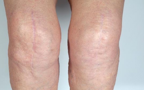 缺血为什么会导致水肿