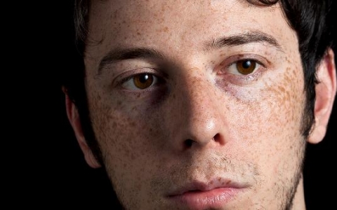 治疗肝斑的好办法是什么