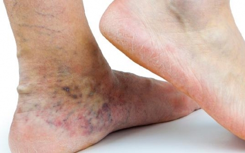 为什么尿酸要控制在350