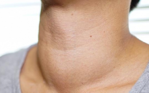 总T4偏高怎么办？