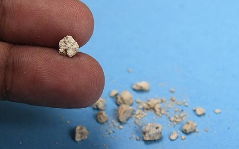 肾脏小结石需要治疗吗