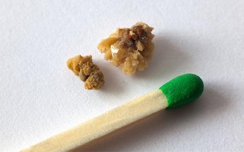 怎么知道自己结石排出