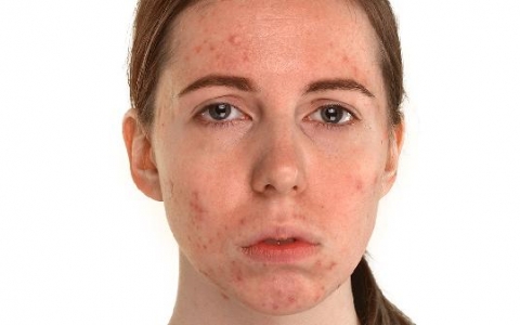 全身过敏了手上比较严重不知道能不能恢复